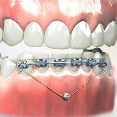 Getting Invisalign Invisalign in El Paso